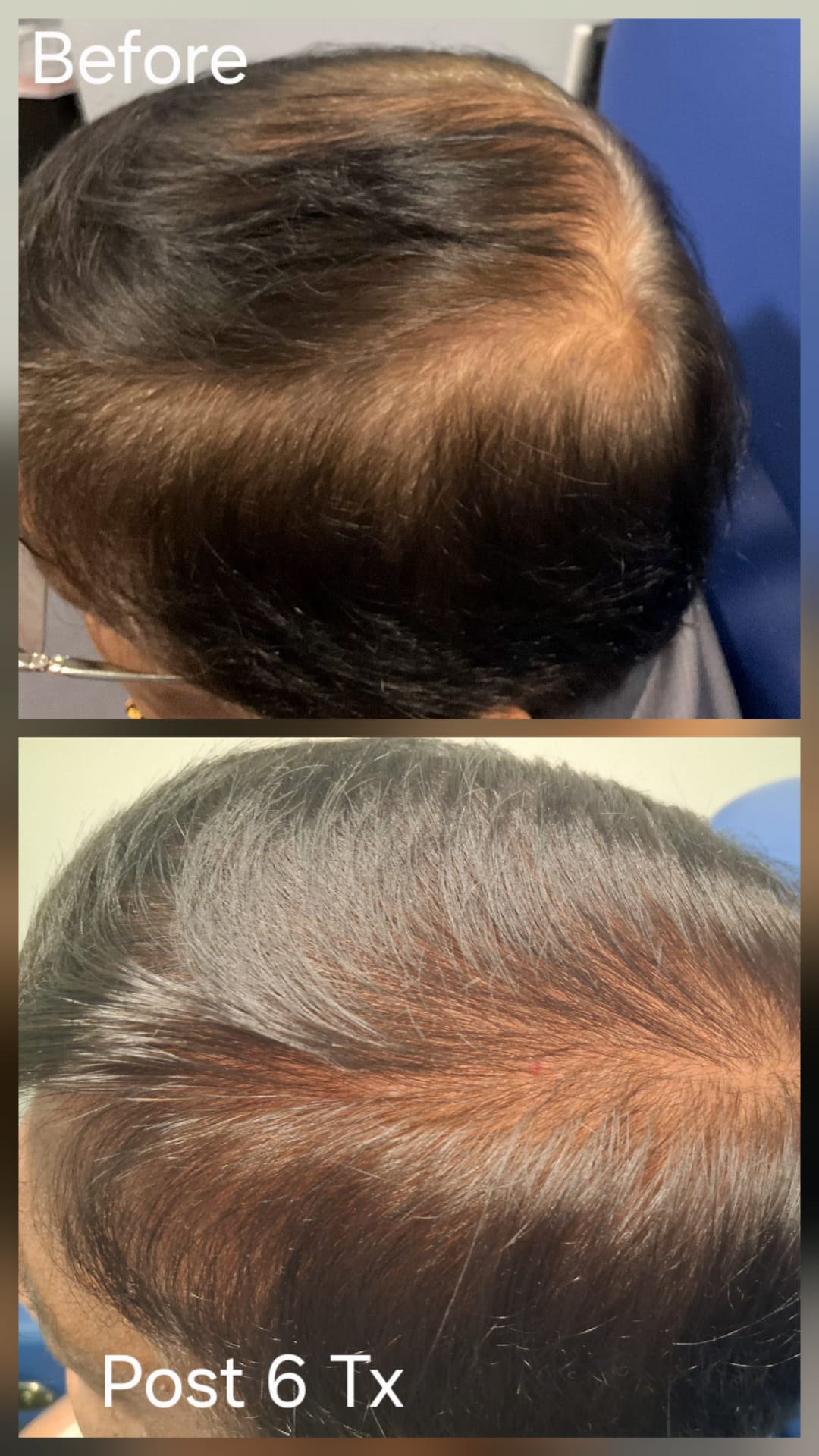 Hair restoration result